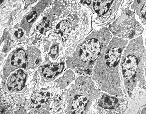 celiakia- plasmocytes in lamina propria celiakia- plasmocytes in lamina propria